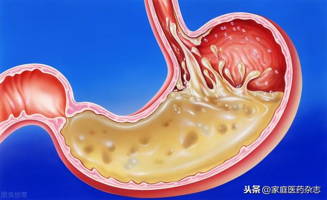 警惕！反流性食管炎的4种典型症状，早发现早治疗