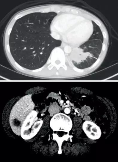 打破传统治疗标准！拉罗替尼挑战转移性非小细胞肺癌的一线治疗
