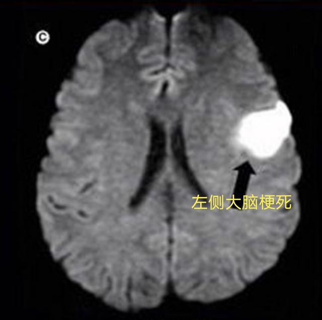 50岁女性3个月两次脑梗，抽丝剥茧，原来心脏有个“破洞”