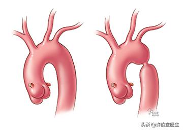 儿童高血压，一个容易忽视的健康问题