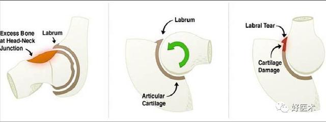 一文读懂髋关节撞击综合征