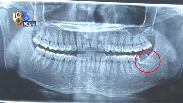 牙齿|想拔左侧智齿，医生为何拔了右边？