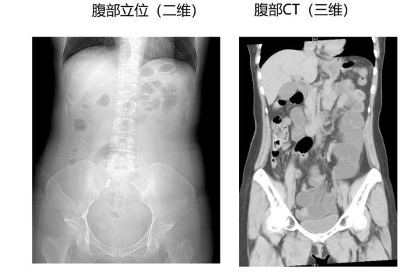 肠梗阻|腹痛腹胀，小心肠梗阻