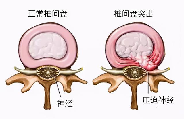 腰椎间盘突出症80%-90%不需要手术，可以这样治....