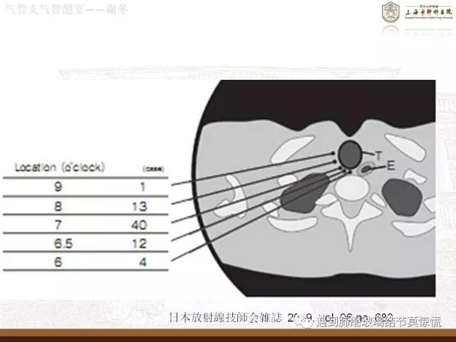 遇到气管、支气管憩室莫惊慌