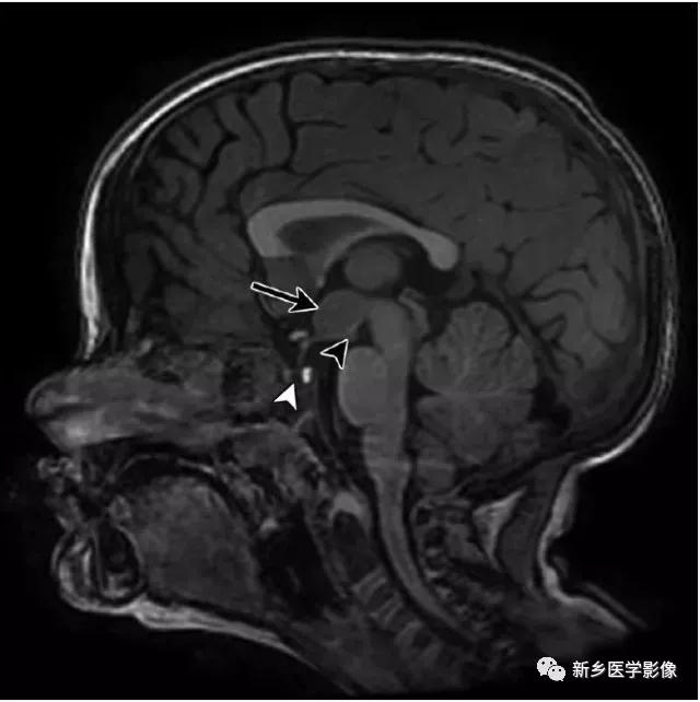 大脑中线处常见的25种疾病