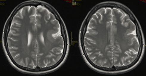 医影学堂丨八个病例带你看懂脑灰质异位的三种类型