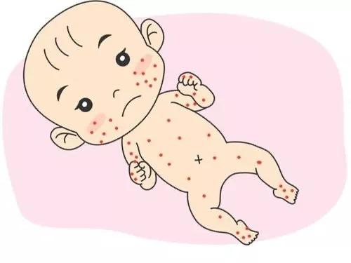 「你的育儿经」新生儿红斑 父母要怎么办？