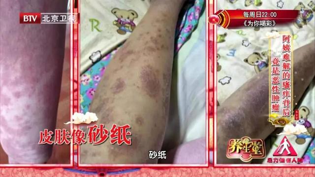 瘙痒|冬季瘙痒难耐，小心背后藏着病！两个药膳方，轻松止痒、升阳补血