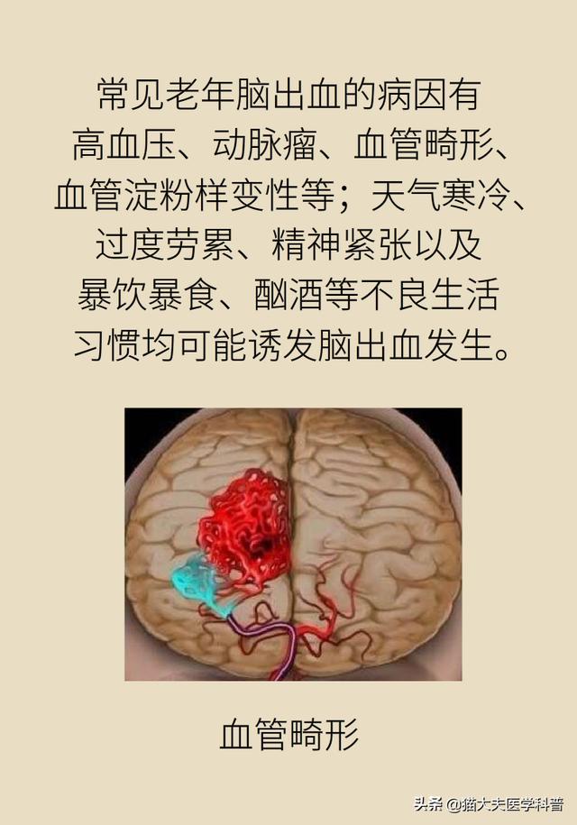 3小时来了7个脑出血患者！预防脑出血注意这8个信号