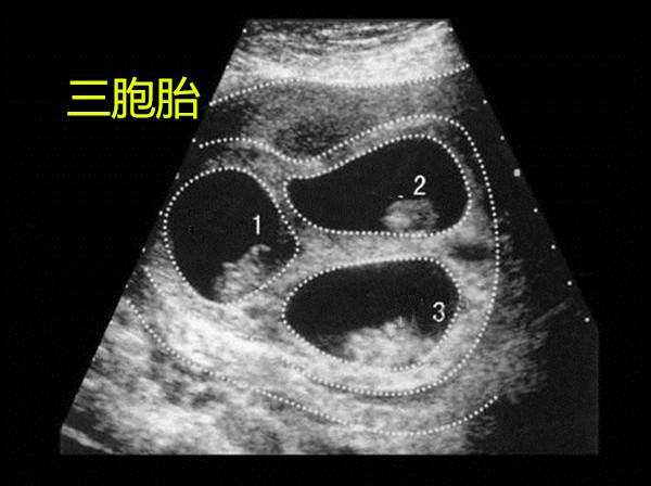 超级宝妈▲胎动总是在左边，就说明怀了男孩吗？胎宝宝“运动”是有原因的