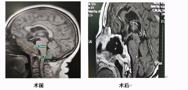 可怕！大妈流“鼻涕”长达一个月，医生却说：“你流的是脑脊液”