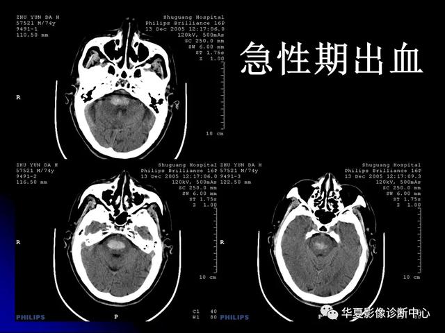 「影像复习」脑干区常见病变影像表现