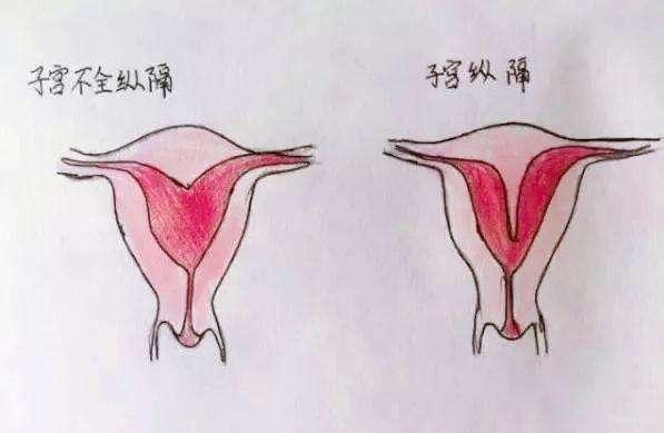 「超级宝妈」什么是不完全子宫纵膈？得了这个病还能生孩子吗？