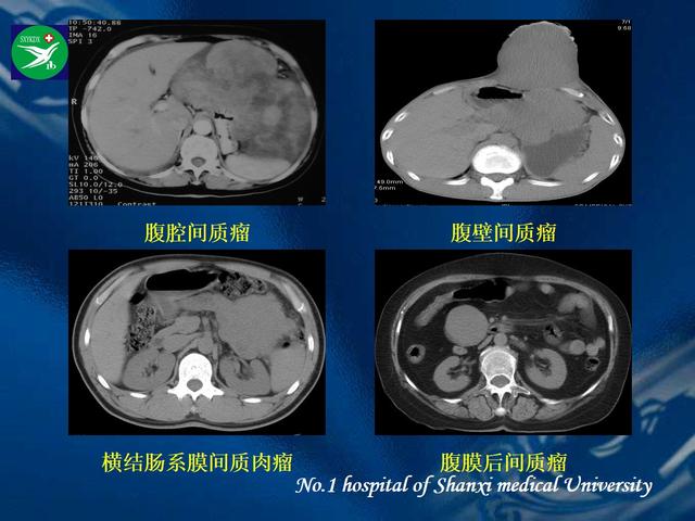 李健丁教授：胃肠道外间质瘤的CT表现和临床病理分析