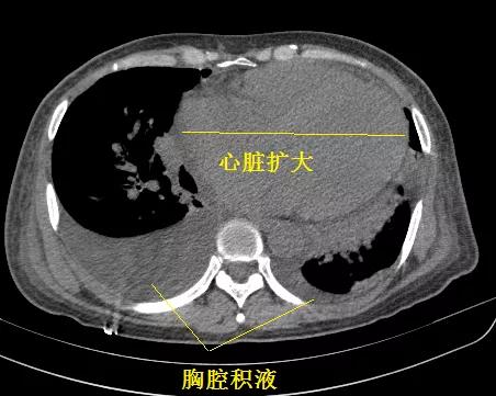 「典型」的肺水肿，为何用抗生素狂轰滥炸？