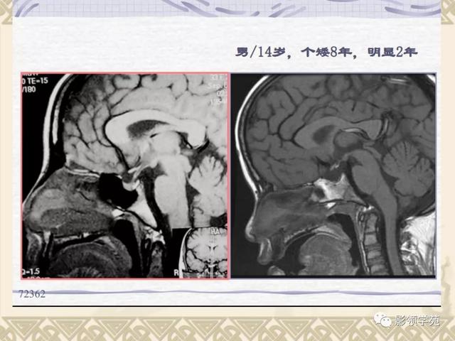 垂体病变的MRI诊断