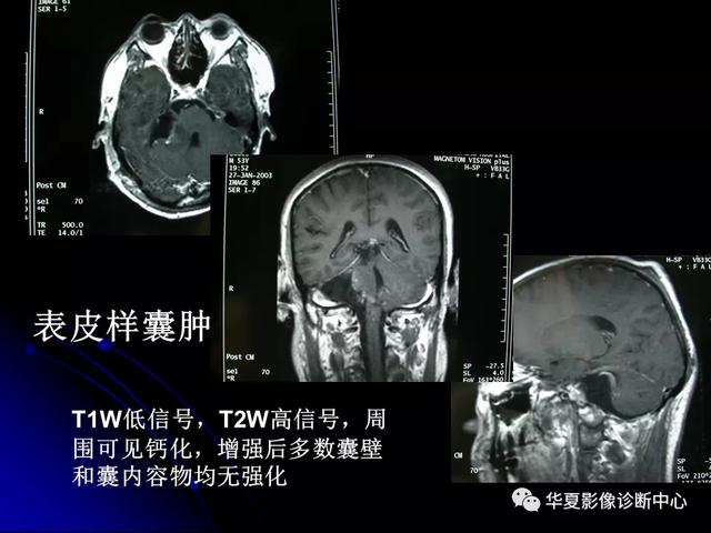 「影像复习」脑干区常见病变影像表现