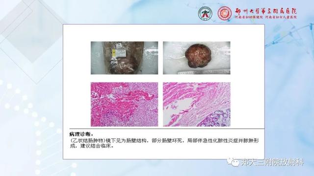 儿童腹部囊性病变诊断思路分析