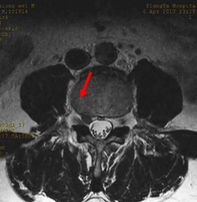 拿到片子不会看？6 种「椎间盘突出」的影像征象需注意