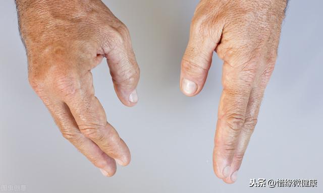 「惜缘微健康」重新认识类风湿性关节炎并不是不治之症及康复方案