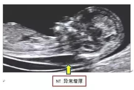 超级宝妈▲怀孕3个月突然腹痛，可不要大意认为是胎动!