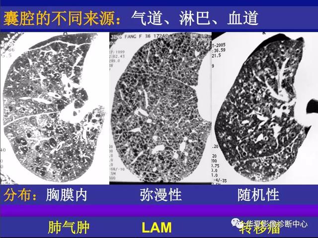 肺间质性疾病的解剖、病理、影像分析