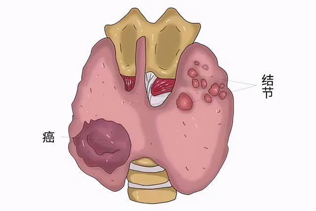 为啥甲状腺癌发病率会逐年增长？医生坦言：无关饮食，与1事有关