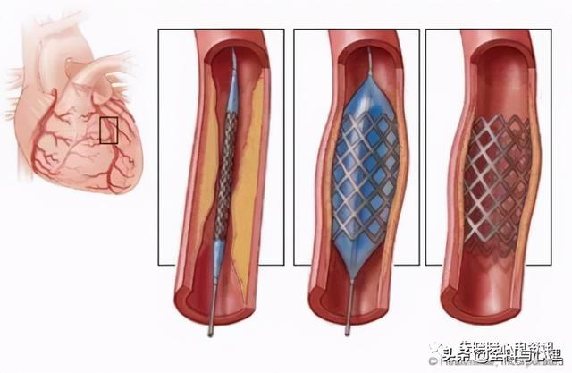 心肌梗死发作如何识别，如何自救？（附心梗地图）
