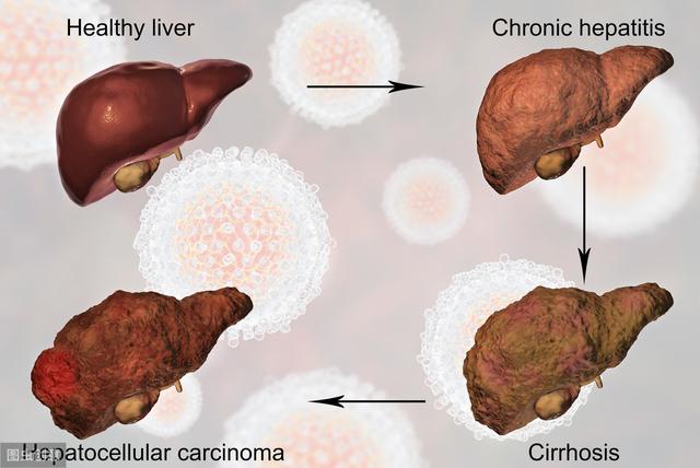 肝癌演变的3个过程,早期癌症的5个表现,如果你占三个