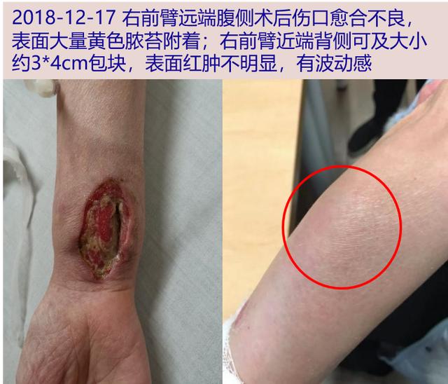 青年女子伤口狰狞、半年不愈，涂片检查发现元凶竟然是它……