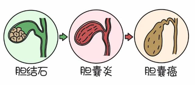 专家答疑丨无症状的胆囊结石到底该不该治？