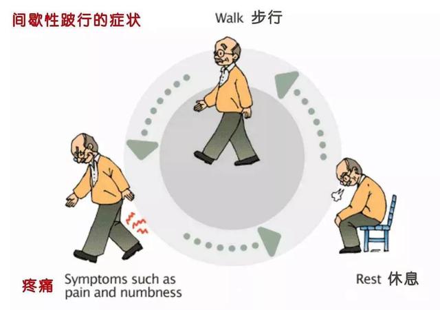 年过50的朋友们注意了，出现这几个症状，多半是腰椎管狭窄来袭