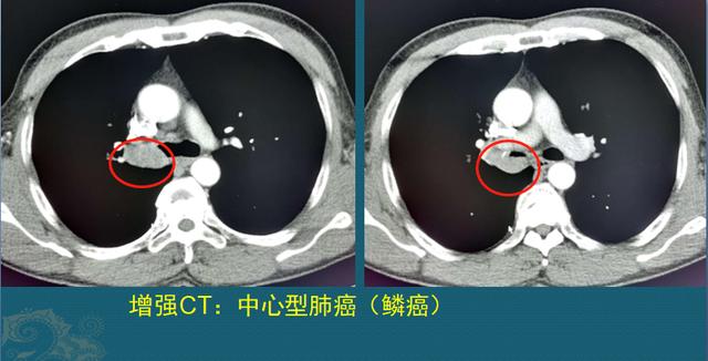 肺癌能治好吗？医生解释3个阶段的治疗数据，避免人财两空