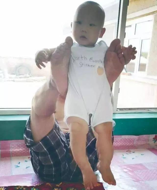 老鹰捉小鸡|满月宝宝患重症，亲友劝放弃，爸爸：“再生一个就不是他了”