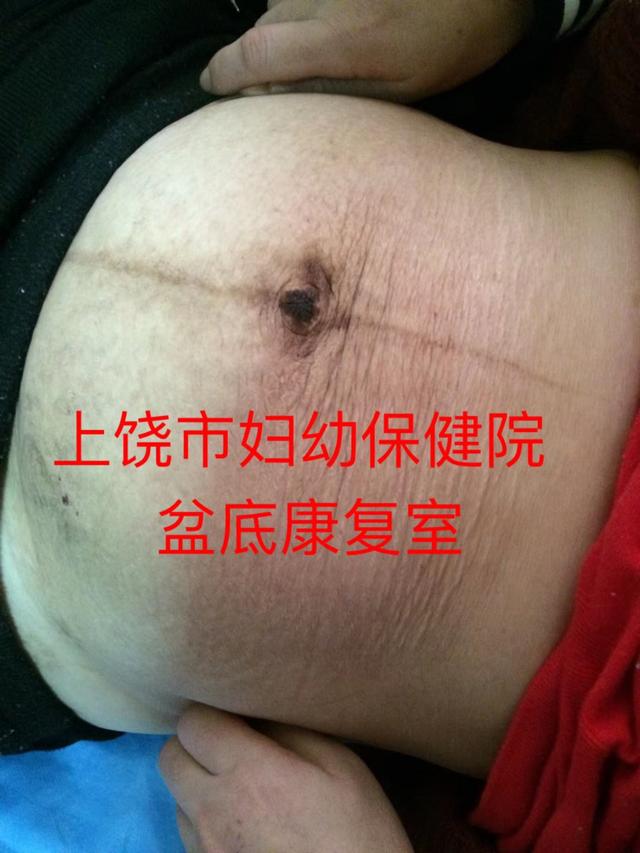 你的育儿经■【女性健康】高龄产妇产后腹直肌严重分离，在家该如何自测恢复？