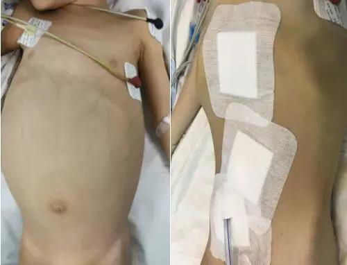 超级宝妈▲2岁男孩肚子越来越鼓 一查原因后家长懵了