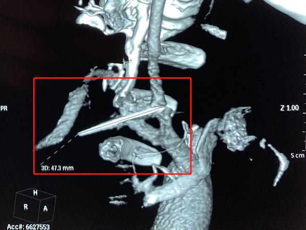 血管|小伙颈部取出“神秘飞针”！手术中同仁大夫都屏住了呼吸
