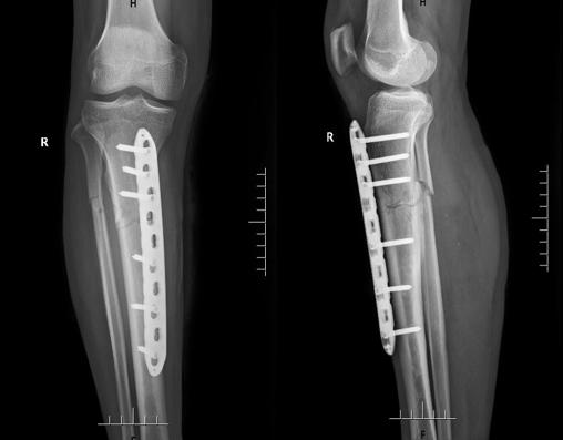 手术|鲁东医院骨科团队妙用钢板外置微创治疗复杂开放性骨折