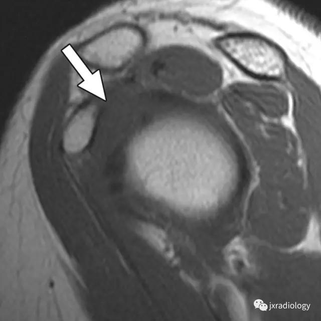 肩袖间隙的解剖及常见病变