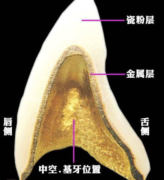 全瓷牙到底比烤瓷牙好在哪？为何医生都首推全瓷？听听牙医的详解