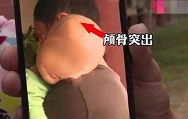 超级宝妈▲再现“大头娃娃”！湖南“假奶粉”坑骗家长，幼儿颅骨突出起湿疹