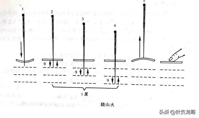 针灸常用补泻手法介绍，建议初学者收藏