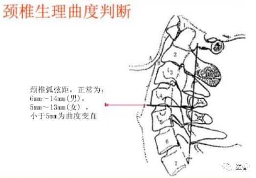 收藏丨手把手教你在X线上如何测量「颈椎生理曲度变直」