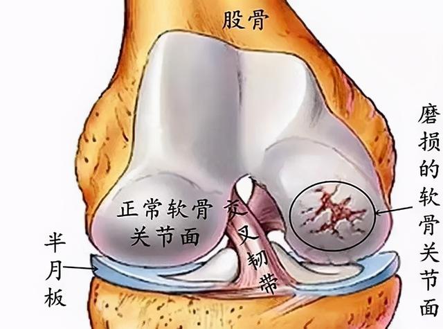 中老年人常受骨关节炎困扰，如何阶梯治疗减轻疼痛避免畸形？