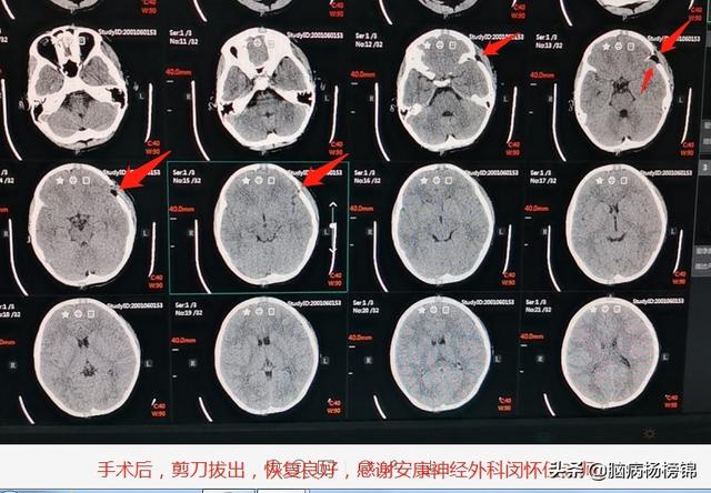 你的育儿经▲熊孩嬉闹 剪刀入脑 上篇飞刀 这个更孬