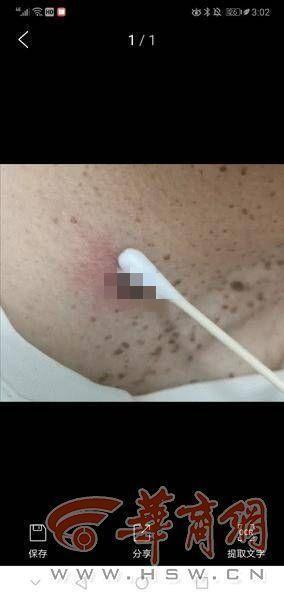 叮咬|71岁大爷颈部忽然冒出“黑痣”4天后竟然发现是蜱虫