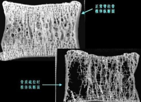 维生素D|如何预防和治疗骨质疏松症