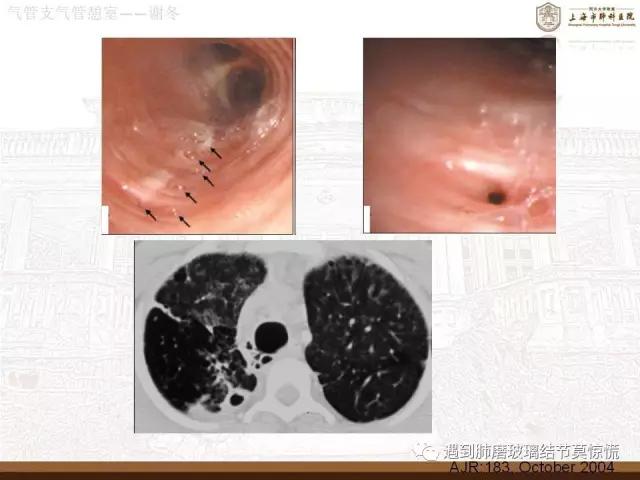 遇到气管、支气管憩室莫惊慌