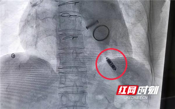 导线|娄底首例无导线心脏起搏器植入术患者出院